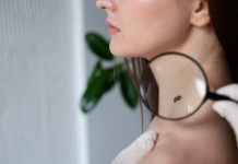 Удаление папиллом: Эффективные способы вернуть коже гладкость