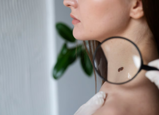 Удаление папиллом: Эффективные способы вернуть коже гладкость