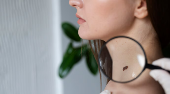 Удаление папиллом: Эффективные способы вернуть коже гладкость