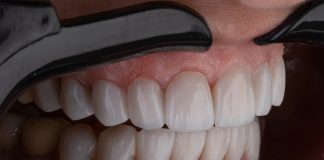 Остеофиты на деснах: причины, симптомы и методы лечения