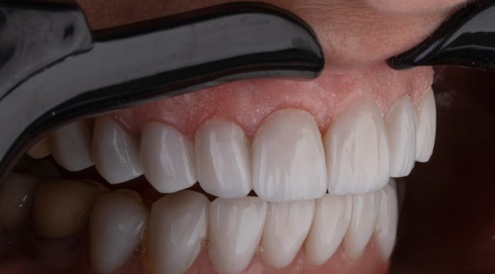 Остеофиты на деснах: причины, симптомы и методы лечения